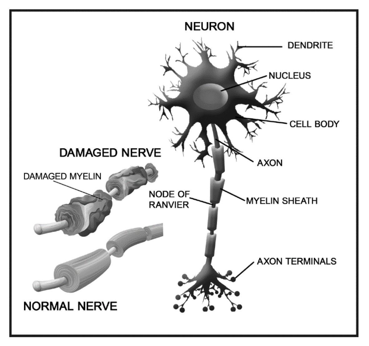 nerve-nurapathy
